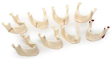 Виды переломов нижней челюсти  (комплект из 8 моделей) (5х9х9 см / 0,36 кг)