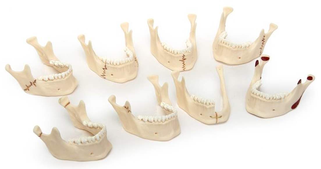 Виды переломов нижней челюсти  (комплект из 8 моделей) (5х9х9 см / 0,36 кг)